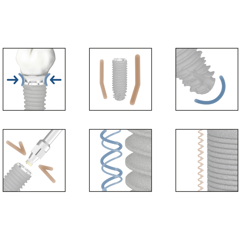 TBR-Dental-implantsBL-options